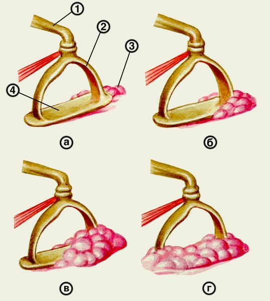 Рис. 2. Схематическое изображение вариантов фиксации основания стремени при отосклерозе: а — <a href=