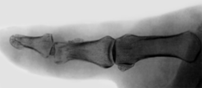 Рис. 7. Рентгенограмма пальца при костно-суставном панариции: деструкция суставных концов с подвывихом в суставе