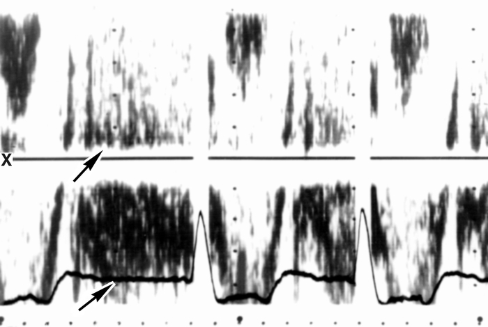 Рис. 19. Допплер-эхокардиограмма (спектрограмма) потоков крови в выходном тракте левого желудочка сердца у больного с недостаточностью портального клапана: в систолу (сразу за желудочковым комплексом зарегистрированной под спектрограммой ЭКГ) эхосигналы располагаются ниже изолинии х (поток направлен от датчика), имеют четкую очерченность и светлое «окно», свидетельствующие о ламинарном (нормальном) потоке; в диастолу (за рубцом Т ЭКГ) регистрируются эхосигналы (указаны стрелками) в виде сплошной полосы без светлого «окна» как ниже, так и выше изолинии, соответствующие турбулентному потоку аортальной регургитации