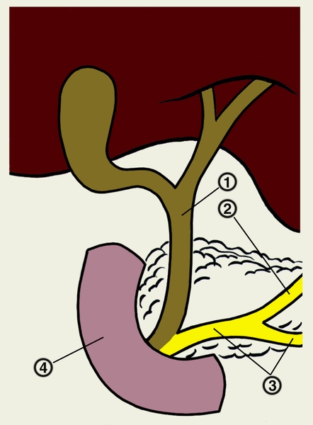 Рис. 2. Схема соединения общего желчного и панкреатического протоков с образованием общей печеночно-поджелудочной ампулы: 1 — общий желчный проток; 2 — добавочный <a href=