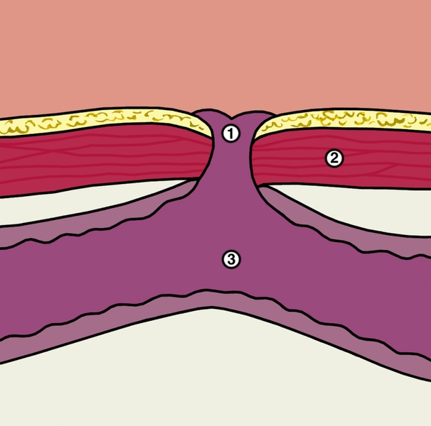 Рис. 2. Схематическое изображение трубчатого кишечного свища (на разрезе): 1 — отверстие свища; 2 — <a href=