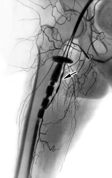Рис. 9. Артериограмма правой бедренной артерии при ее окклюзии: зона окклюзии указана стрелкой