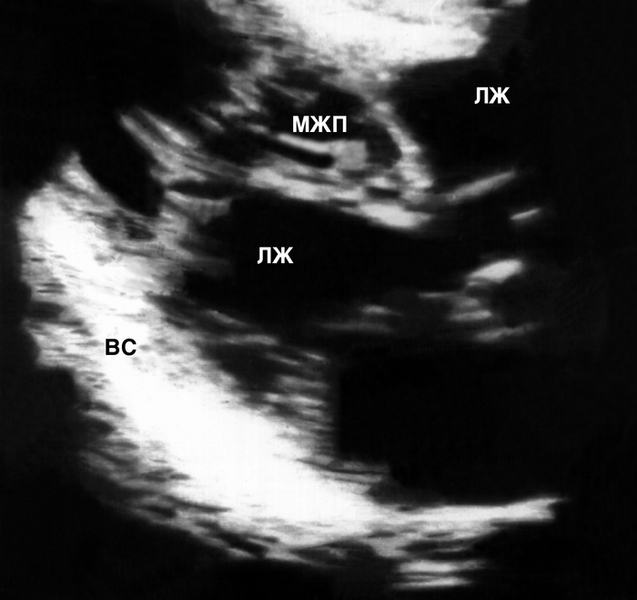 Рис. 5а). Двухмерная эхокардиограмма при верхушечной кардиомиопатии: ПЖ — правый желудочек, МЖП — межжелудочковая перегородка, ЛЖ — левый желудочек, ВС — верхушка сердца. Видно значительное нарастание толщины миокарда левого желудочка в направлении от основания к верхушке сердца