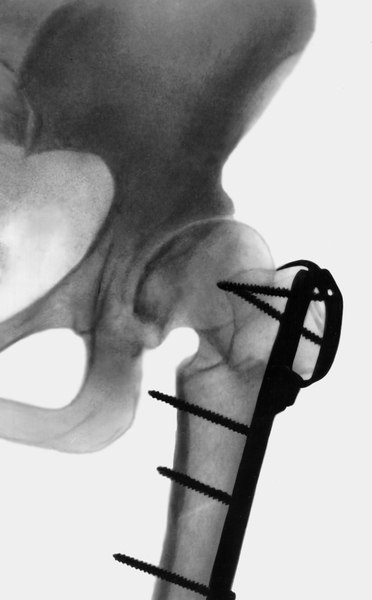 Рис. 3б). Варизирующая остеотомия проксимального конца бедренной кости при коксартрозе: <a href=