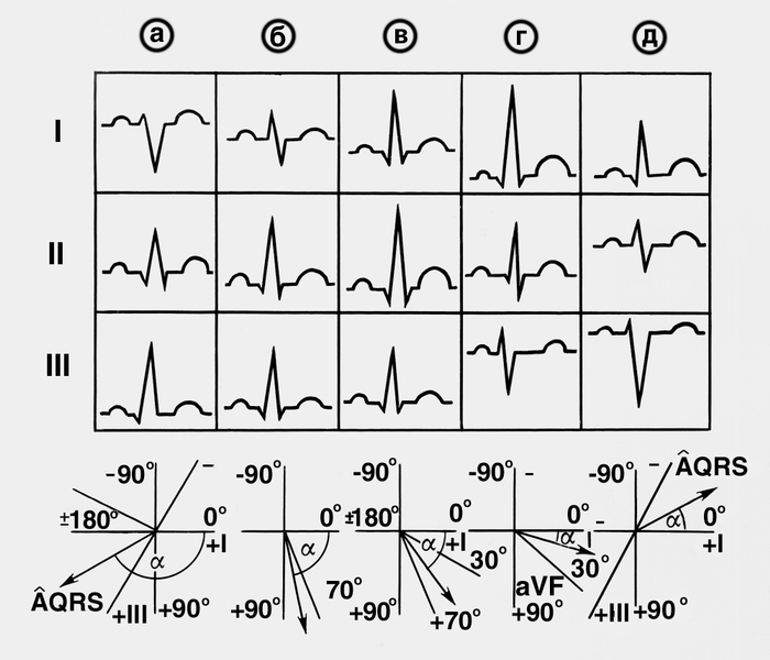 Рис. 6. Варианты электрокардиограммы в отведениях I, II, III при различном положении электрической оси сердца: а — отклонение вправо; б — вертикальное положение; в — нормальное положение; г — горизонтальное положение; д — отклонение влево. На диаграммах внизу — величина (∠α при соответствующем положении электрической оси (ось обозначена стрелкой)