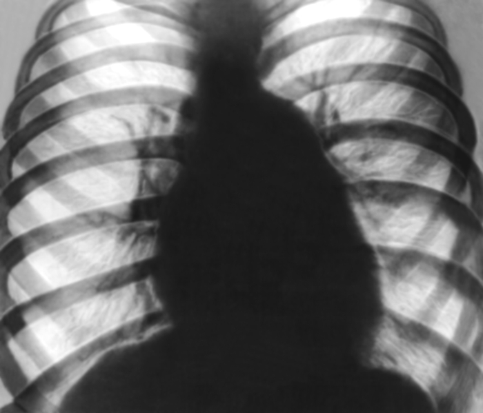 Рис. 10в). Рентгенограмма грудной клетки больного с митральным стенозом (передняя проекция): выраженные признаки легочной гипертензии, резко выбухает дуга легочного ствола, корни легких расширены, но структурны, расширенные тени артериальных ветвей как бы обрываются (симптом «ампутации»), <a href=