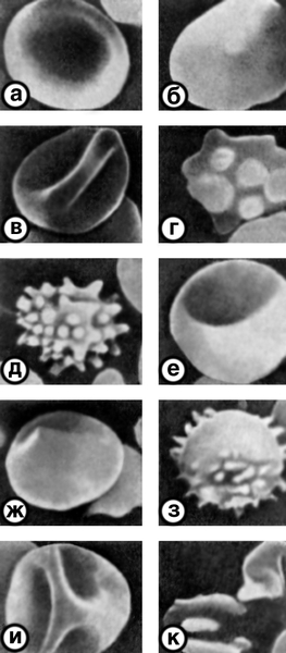 Рис. 2. Различные формы эритроцитов, выявляемые при сканирующей электронной микроскопии: а, б — дискоцит; в — дискоцит с гребнем; г — дискоцит с множественными выростами; д — <a href=
