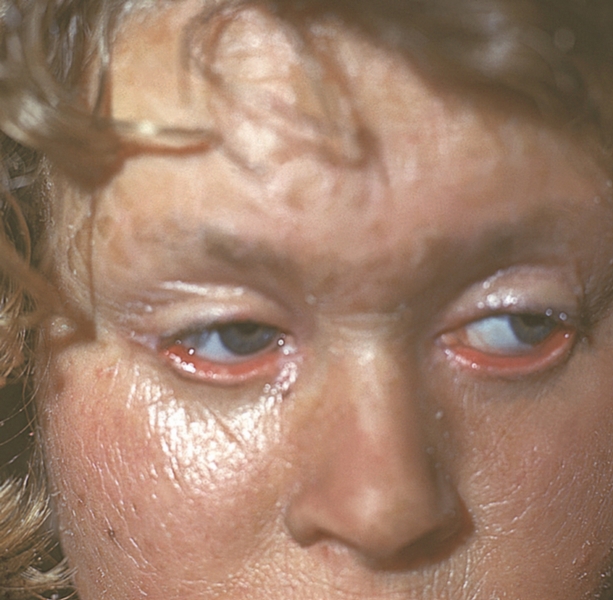 Рис. 5. Проявления ламеллярного ихтиоза: поражение кожи лица с выворотом век