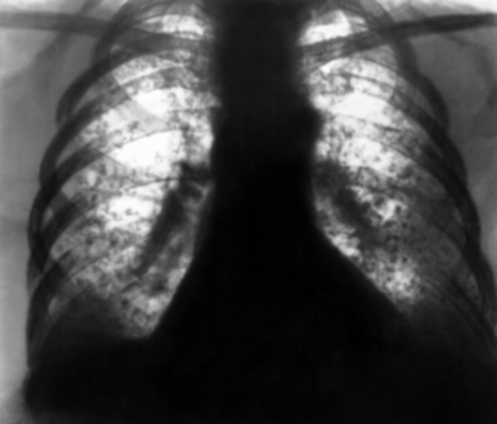 Рис. 26. Рентгенограмма органов грудной клетки в прямой проекции при мелкоузелковой форме силикотуберкулеза: определяются множественные мелкие плотные тени (узелки) с выраженной кальцинацией в центре каждой на всем протяжении обоих легочных полей, плевральные <a href=