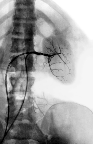 Рис. 8. Селективная почечная артериограмма при гидронефрозе: сегментарные артерии левой почки истончены, артериальный рисунок обеднен