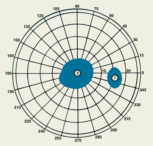 Рис. б). Изображение патологических скотом на скотометрических схемах при исследовании поля зрения правого глаза: 1 — слепое пятно; 3 — центральная скотома