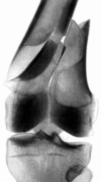 Рис. 22а). Рентгенограмма коленного сустава при переломе обоих мыщелков бедренной кости со смещением: прямая проекция