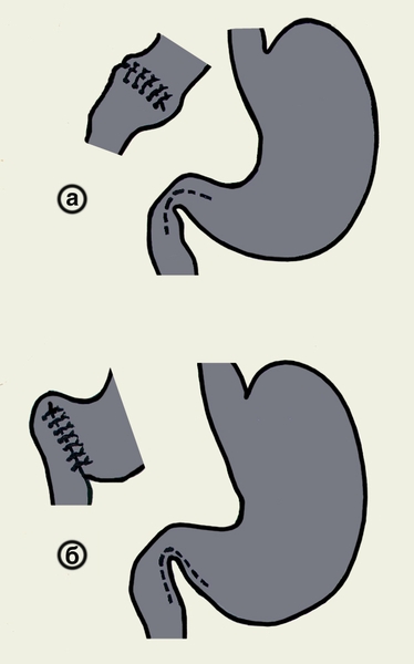 Рис. 7. Схематическое изображение пилоропластики (пунктиром обозначены линии рассечения): а — по Гейнеке — Микуличу (привратниковая часть желудка и двенадцатиперстная кишка рассекаются вдоль, образовавшееся отверстие ушивается в поперечном направлении); б — по Финнею (наложение анастомоза между антральным отделом желудка и двенадцатиперстной кишкой)