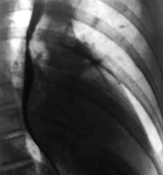 Рис. 10б). Рентгенограмма грудной клетки больного с митральным стенозом (правая косая проекция): контрастированный пищевод отклоняется по дуге малого радиуса