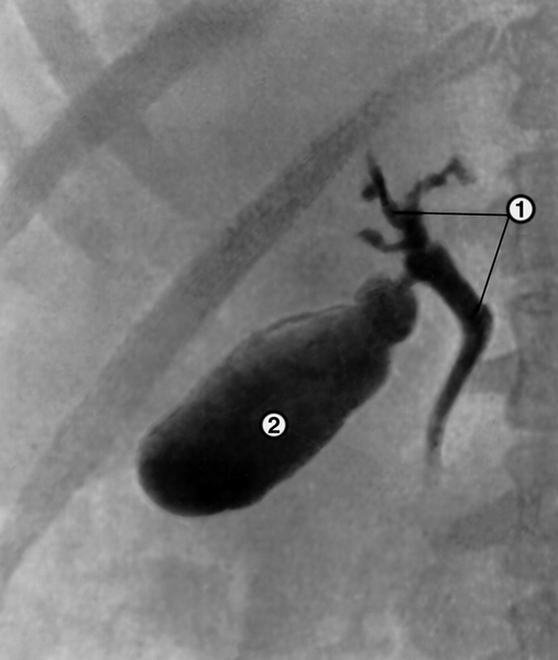 Рис. 1. Холеграмма в норме: 1 — тени крупных желчных протоков; 2 — тень желчного пузыря