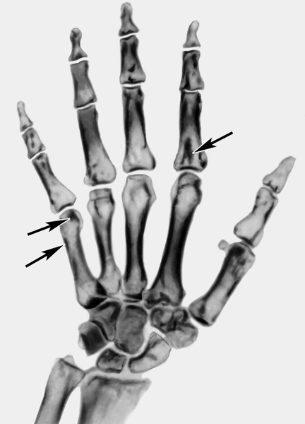 Рентгенограмма кисти (прямая проекция) при остеопойкилии: видны расположенные эндостально в губчатом веществе мелкоочаговые скопления склерозированной костной ткани (указаны стрелками)