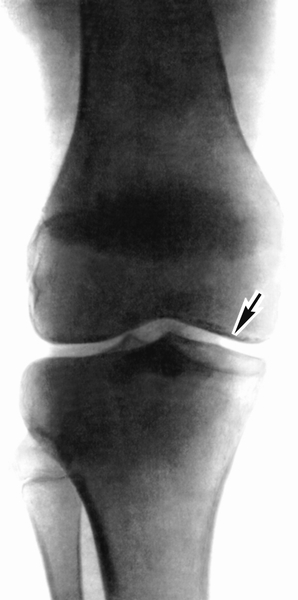 Рентгенограмма правого коленного сустава при болезни Кенига во II фазе процесса (прямая проекция): нарушение целости замыкательной пластинки в зоне остеонекроза (указано стрелкой)
