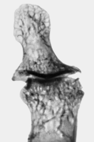 Рентгенограмма дистального межфалангового сустава II пальца (прямая проекция) при остеоартрозе суставов кисти: <a href=