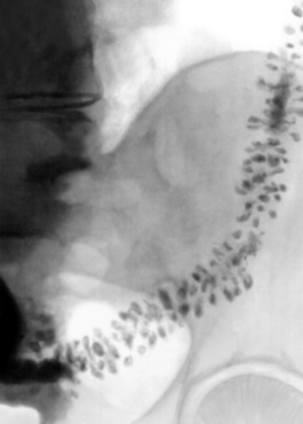 Рис. 6. Рентгенограмма сигмовидной ободочной кишки при дивертикулезе: имеются множественные мешковидные расширения, выходящие за пределы стенки кишки