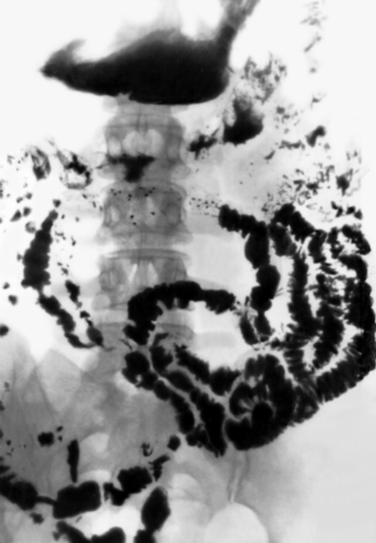 Рис. 2. Рентгенограмма тонкой кишки при хроническом энтерите: видно неравномерное распределение бариевой взвеси по кишечнику