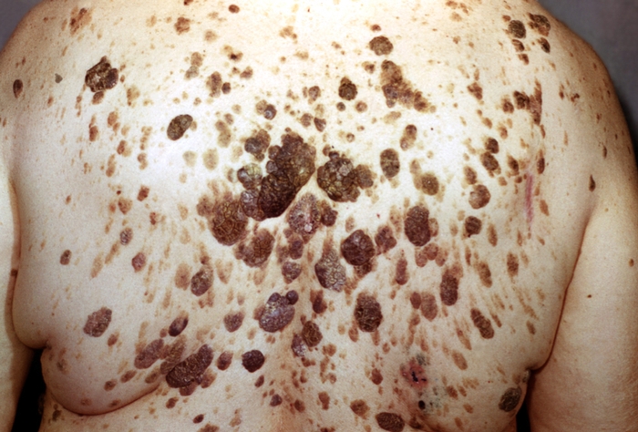 Рис. 3. Себорейный кератоз: множественные гиперпигментированные покрытые корками бляшки на коже спины