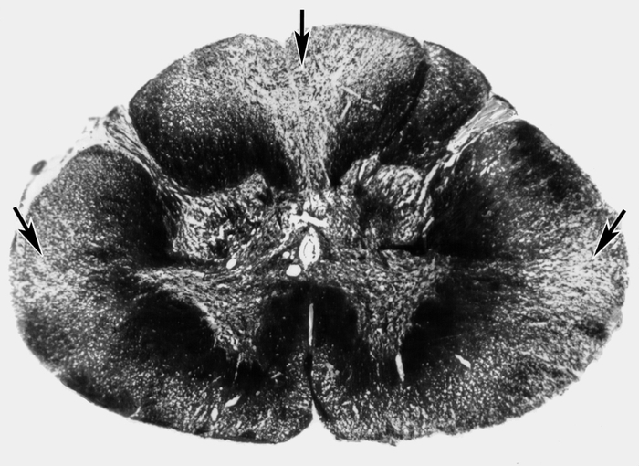Микропрепарат спинного мозга при миелополирадикулоневрите: стрелками указаны очаги демиелинизации