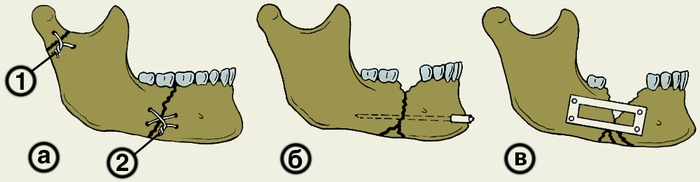 Рис. 5. Схема различных видов остеосинтеза при переломах нижней челюсти: а — костный шов проволокой (1 — одинарный, 2 — двойной крестообразный); б — внутрикостное скрепление отломков металлическим штифтом; в — скрепление отломков с помощью металлической рамки