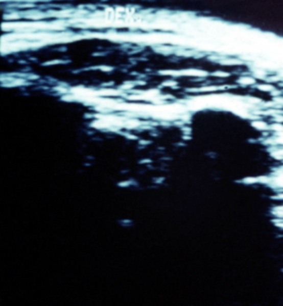 Рис. 15а). Ультрасонограмма передней поверхности правого плечевого сустава при хондроматозе левого плечевого сустава: эхогенность клювовидно-акромиальной связки значительно снижена, под ней определяются гиперэхогенные фокусы (указаны стрелками), соответствующие зоне поражения