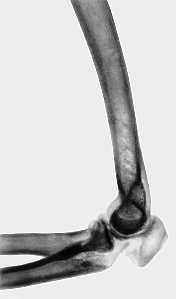 Рис. 10а). Рентгенограмма локтевого сустава (боковая проекция) при переломе локтевого отростка с расхождением отломков — до операции
