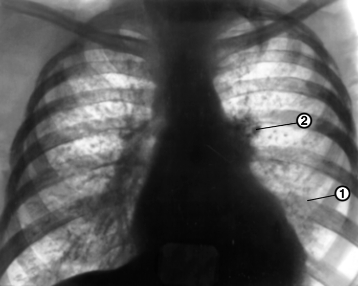 Рис. 6. Рентгенограмма органов грудной клетки в прямой проекции при гематогенно-диссеминированном туберкулезе легких: в обоих легких видны множественные средней интенсивности четко очерченные тени диаметром 2—3 мм, слева определяется обызвествленный первичный туберкулезный комплекс — кальцинированный очаг в легочной ткани на уровне пятого межреберья (1) и крупные кальцинаты в корне левого легкого (2)