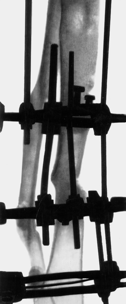 Рис. 24а). Рентгенограмма голени больного с хроническим посттравматическим остеомиелитом: компрессия с помощью аппарата Илизарова отломков большеберцовой кости, видны костные мозоли