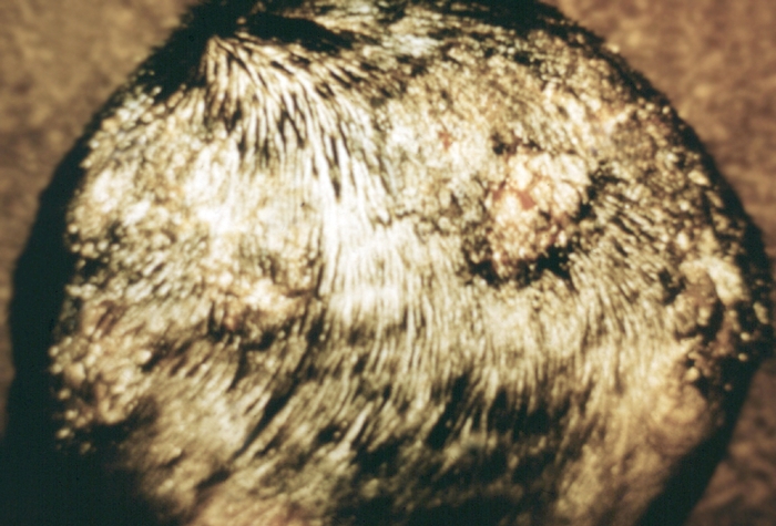 Рис. 6. Гнойное отделяемое из фолликулярных абсцессов на волосистой части головы при инфильтративно-нагноительной трихофитии
