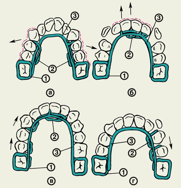 Рис. 5. Схематическое изображение действия аппарата Мершона для расширения зубного ряда (а), выдвижения резцов вперед (б), медиального перемещения зубов (в), дистального перемещения зубов (г): 1 — кольца для фиксации аппарата на зубах; 2 — упругие отростки; 3 — лингвальная дуга; стрелками указаны направления перемещения зубов в процессе лечения