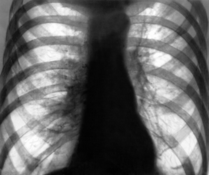 Рис. 1а). Рентгенограмма грудной клетки в прямой проекции при везикулярной диффузной эмфиземе легких: отмечаются тотальное двустороннее повышение прозрачности легочных полей, обеднение сосудистого рисунка по периферии при усилении его в центральных отделах, расширение корней легких и уплощение диафрагмы