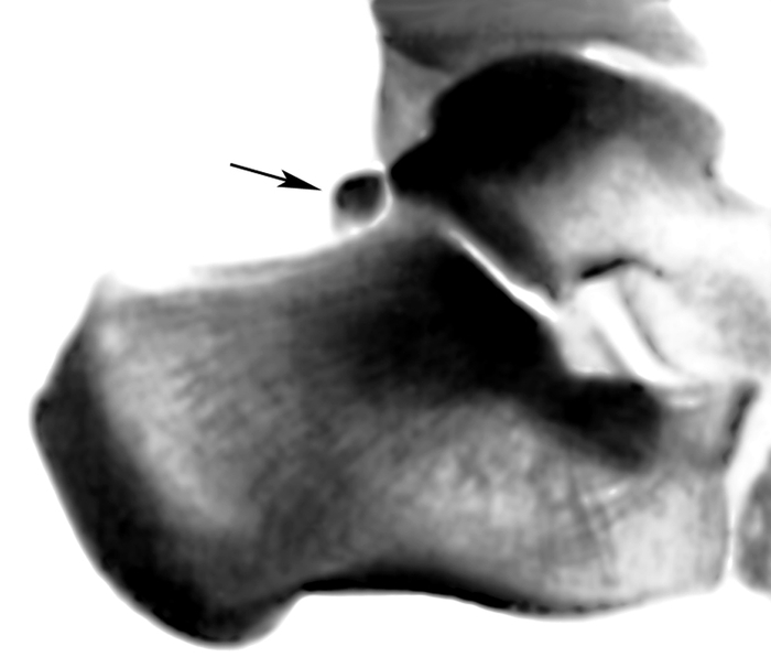 Рис. 2д). Рентгенограммы голеностопного сустава в норме: добавочная косточка таранной кости (указана стрелкой)
