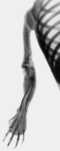 Рис. 2г). Рентгенограмма правой верхней конечности при прогрессирующем остеолизе плечевой кости: прогрессирующее рассасывание трансплантанта