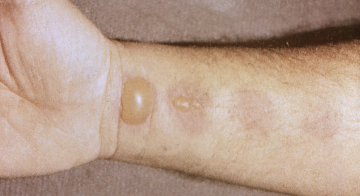 Рис. 2. Аллергический дерматит на внутренней стороне предплечья, обусловленный воздействием растительного аллергена
