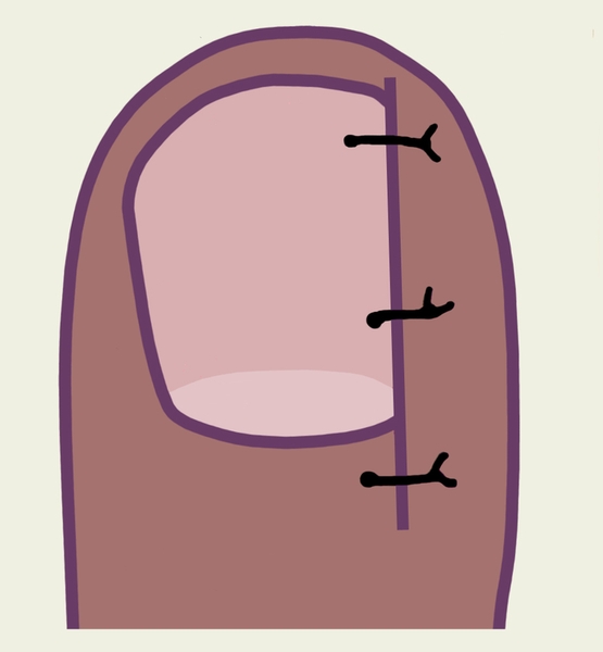 Рис. б). Схематическое изображение этапов операции по поводу вросшего ногтя: на рану наложены швы