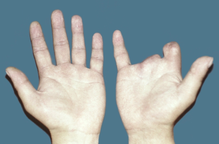 Рис. 2а). Результаты аутотрансплантации пальцев стопы на кисть при посттравматическом отсутствии II, III и IV пальцев правой кисти — до начала лечения