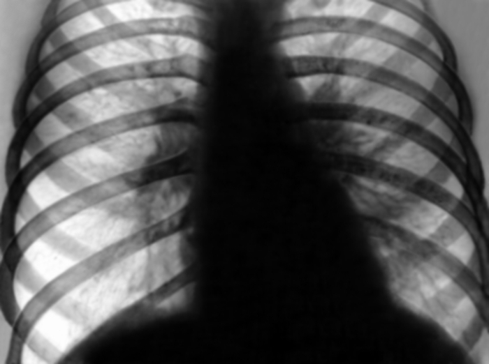 Рис. 11а). Рентгенограмма грудной клетки больного с декомпенсированным митральным стенозом: до операции комиссуротомии (резко выражен застой в легких)