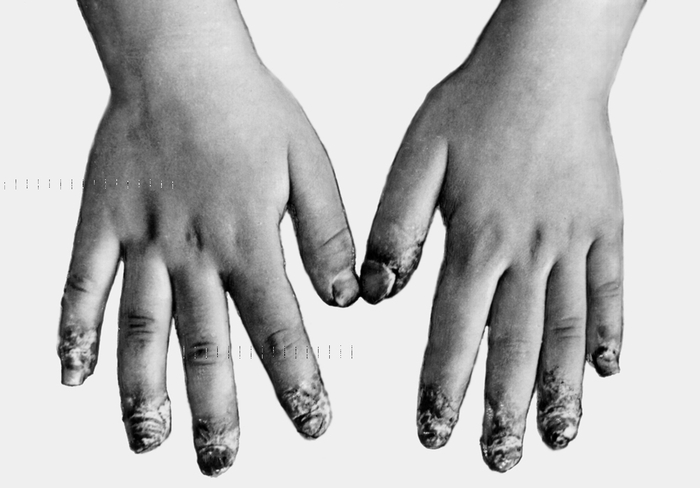 Рис. 3. Эритематозно-сквамозные и пузырьково-пустулезные высыпания на концевых фалангах пальцев; дистрофия ногтей у больного пустулезным акродерматитом