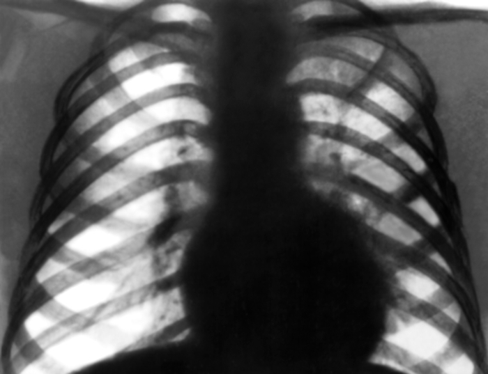 Рис. 11. Рентгенограмма органов грудной клетки в прямой проекции при облаковидном инфильтрате левого легкого: в левом легком на уровне первого и второго межреберных промежутков определяется участок слабо интенсивного затенения с нечеткими контурами