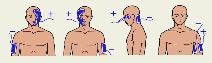 Рис. 4. Места наложения электродов при гальванизации лица. Рис. 5.Места наложения электродов при гальванизации головы. Рис. 6. «Ионные рефлексы» по Щербаку
