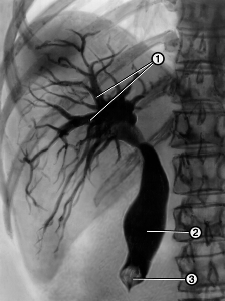 Рис. 1. Рентгенограмма, полученная при чрескожной чрезпеченочной холангиографии у больного желчнокаменной болезнью: желчные протоки (1) и общий желчный проток (2) расширены, в дистальной части общего желчного протока имеется обтурирующий его <a href=