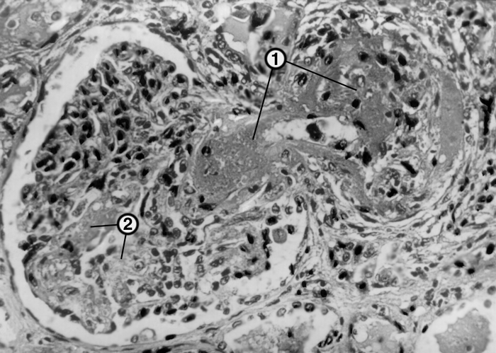 Рис. 3а). Микропрепарат почки при злокачественной форме нефросклероза — в центре виден почечный клубочек с фибриноидным некрозом приводящего сосуда (1) и клубочковых кровеносных капилляров (2); окраска гематоксилином и эозином; ×310