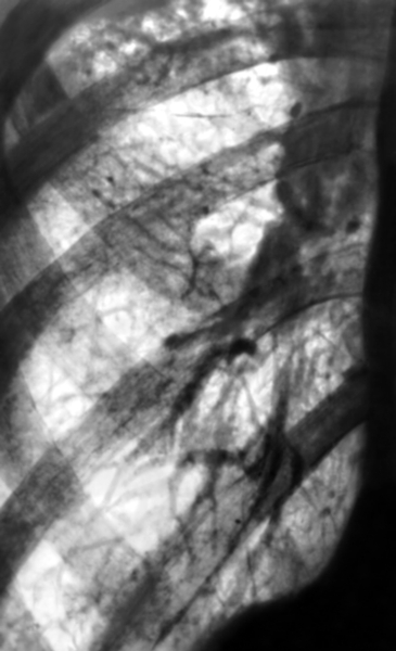 Рис. 5. Фрагмент рентгенограммы грудной клетки при перибронхиальном пневмосклерозе у больного хроническим обструктивным бронхитом: легочный рисунок усилен и деформирован, четко выделяются просветы бронхов, окаймленные утолщенными стенками