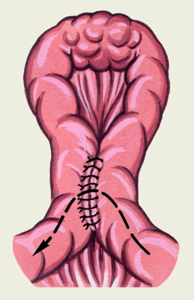 Рис. 7а). Схематическое изображение различных видов кишечного анастомоза: обходной анастомоз при неудаленной опухоли тонкой кишки; стрелкой показано направление продвижения кишечного содержимого