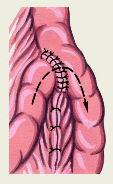 Рис. 7в). Схематическое изображение различных видов кишечного анастомоза: анастомоз конец в бок; стрелкой показано направление продвижения кишечного содержимого