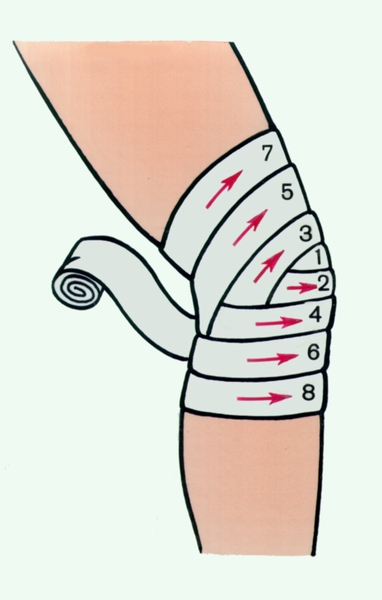 Рис. 3. Бинтовая повязка на коленный сустав. Цифрами и стрелками обозначена последовательность наложения туров бинта