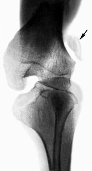 Рис. 14. Рентгенограмма коленного сустава при врожденном вывихе дольчатого надколенника (указан стрелкой)